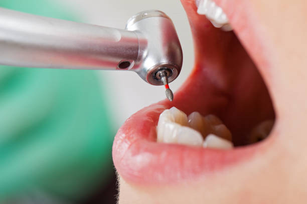 Best Emergency Tooth Extraction in St Charles, MI